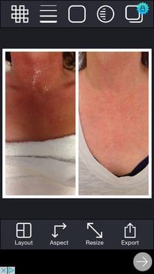 Manasra client before and after IPL  Photofacial of the Décolleté area