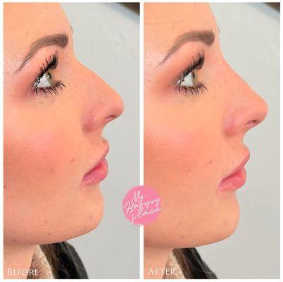 Non-surgical nose transformationShe's gorgeous both ways but I think her nose looks smaller after. What do you guys think?