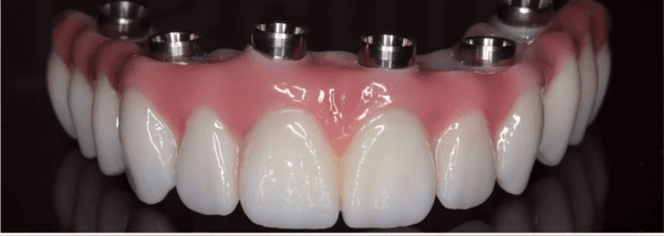 Full mouth upper bridge supported by implants