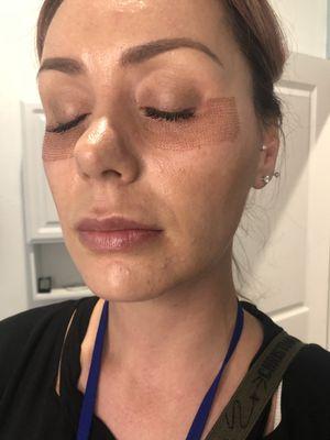 Plasma fibroblast under eye treatment