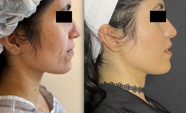 Facial fat grafting volume restoration