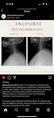 Spine xray being transformed