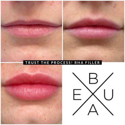 The lip filler slow build process