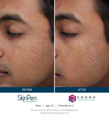 Microneedling for Acne Marks before and after