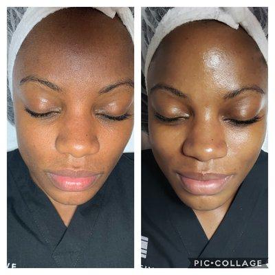 Facial with Manual and Chemical Exfoliation