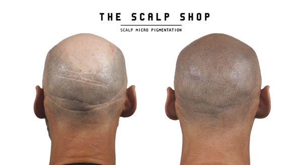 Hair transplant scar camouflage results at The Scalp Shop NYC. Scalp Micropigmentation