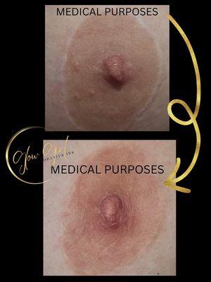 Breast lift scar camouflage