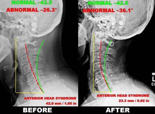 Before After Neck Curve of a Geriatric Patient with Resolution of Neck and Low Back Pain