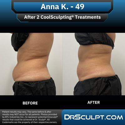 After 2 CoolSculpting treatments on abdomen/flanks