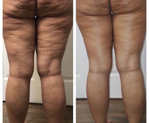 This unique body contouring treatment uses thermal shock to naturally kill fat cells and smooth out cellulite.