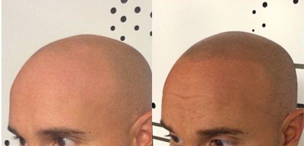 Balding Hairline