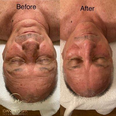 Before and after Microdermabrasion facial with Idan