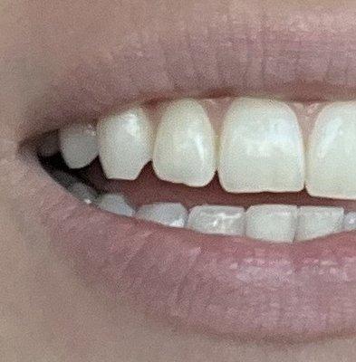 (Top front two teeth) came into fix chipped teeth charged $180 and this is the finished product. Still chipped.