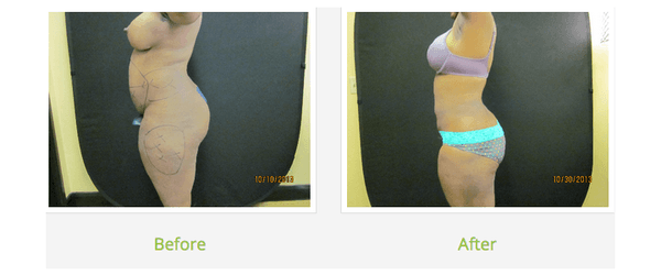 Liposuction results