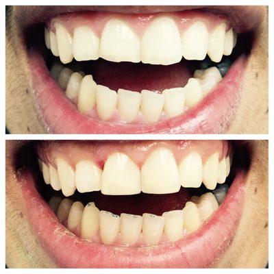 Composite fillings took care of the cavities and restored lost enamel.