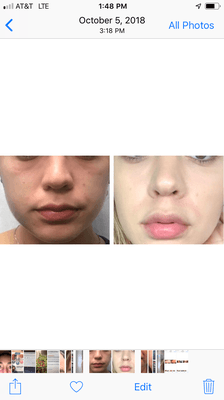 Under eye filler and lip filler