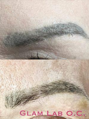 Microblading removal session 1