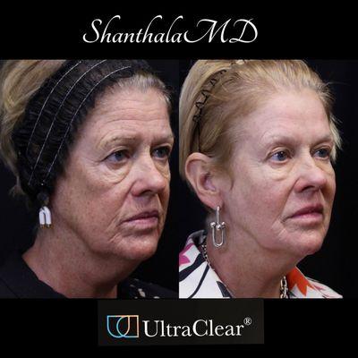 Life changing results Pan facial Rejuvenation  at shanthalaMD