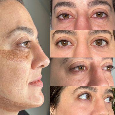 Full face fibroblast before and after