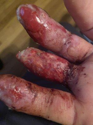 Right hand finger injury needing skin graft