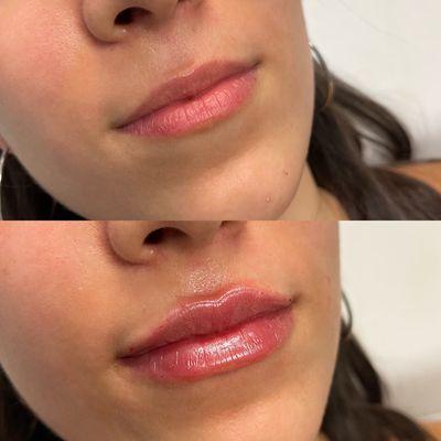 Perfect lips with juvederm lip filler