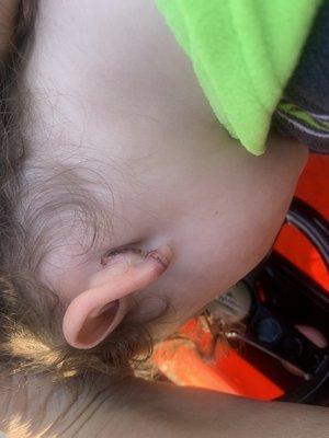 His ear after they glued his ear back on