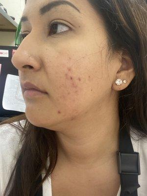 After: No Inflammation, Slightly redness from healing from extractions. No active Acne Yaaaay!!