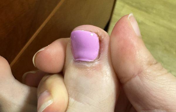 Possibly infected toe from unprofessional nail tech who put nail glue on my toe after cutting it causing it to bleed.