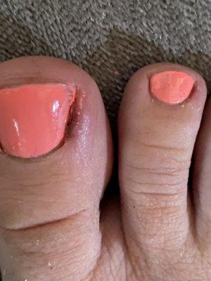 Bleeding infected toe