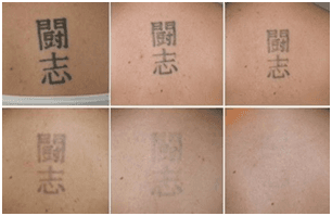 Progression of Laser Tattoo Removal.