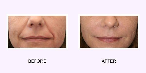 Facial line reduction