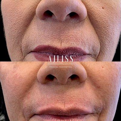 Dermal filler for smile lines