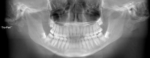 Impacted wisdom teeth