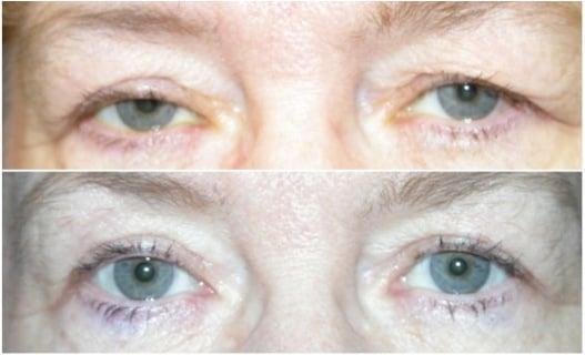 upper eyelid blepharoplasty and ptosis repair