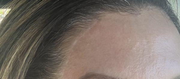 Surgical scar from brow lift