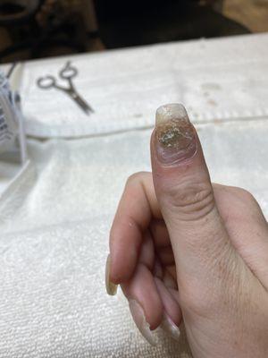 This is a bacterial infection caused by an incorrect fill done by city nails.