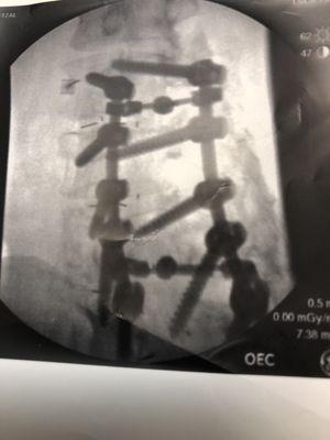 This is what my spine looks like after Doctor Kowalski did his surgery on me. It's horrifying!