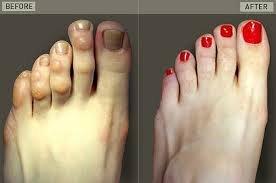 We treat hammertoes!