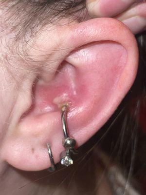 Infected conch piercing, right after cleaning