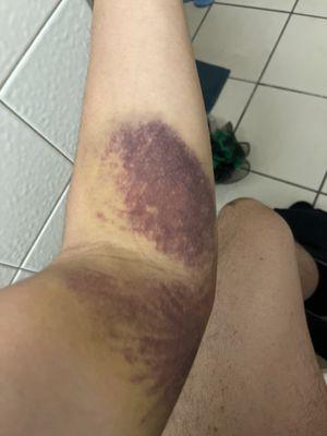 Left arm hematomas after a routine blood draw at Labcorp, Harvard Avenue, Denver