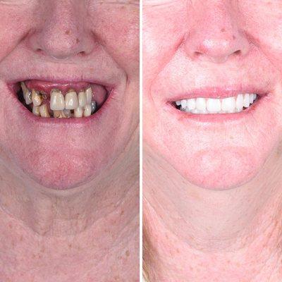 Final results from full mouth dental implants