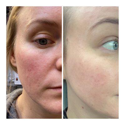 Before and after from Microdermabrasion!