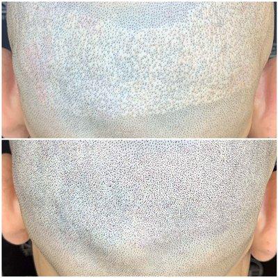 FUE scar camoflauged with Scalp Micropigmentation by Nurse Jenn and Newport SMP