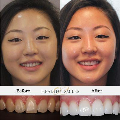 Annas' beautiful & symmetrical smile was achieved with 6 veneers. A missing tooth and unbalanced smile was transformed in just weeks!