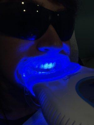 Teeth whitening