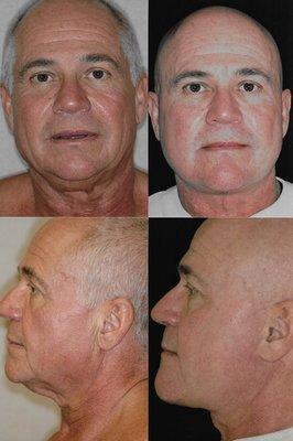 Facelift/Necklift