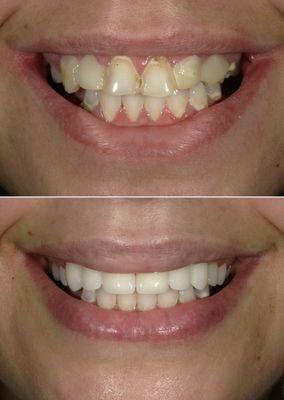 Before and after veneers