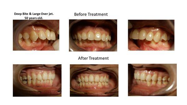 Orthodontic Treatment