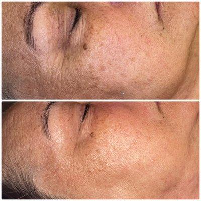 Before and after microdermabrasion facial