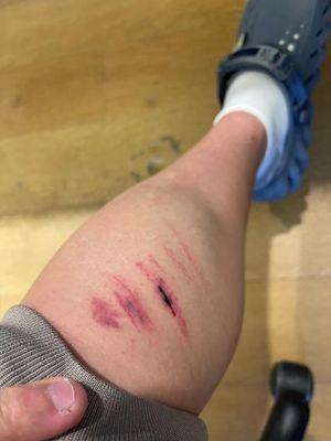 Soccer injury from opponents team